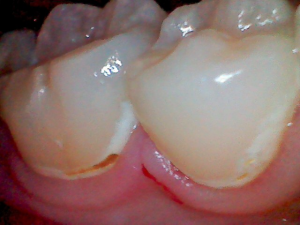 歯肉際の部分の白い帯