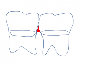 天然歯の歯間空隙