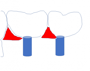 インプラントの上部構造は歯間空隙が大きい