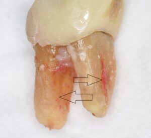 破折歯根の抜去された歯（角度を変えた位置からのもの）
