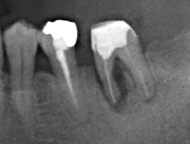 破折歯根のレントゲン写真