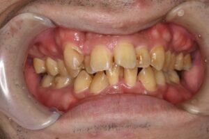 危険な歯並びの実例２