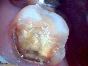 銀歯を外された後の虫歯になっている歯