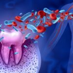 歯周病菌は腸内細菌はじめとして、その方の全身の健康状態に悪影響を与えることがわかってきた