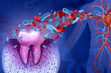 歯周病菌は腸内細菌はじめとして、その方の全身の健康状態に悪影響を与えることがわかってきた